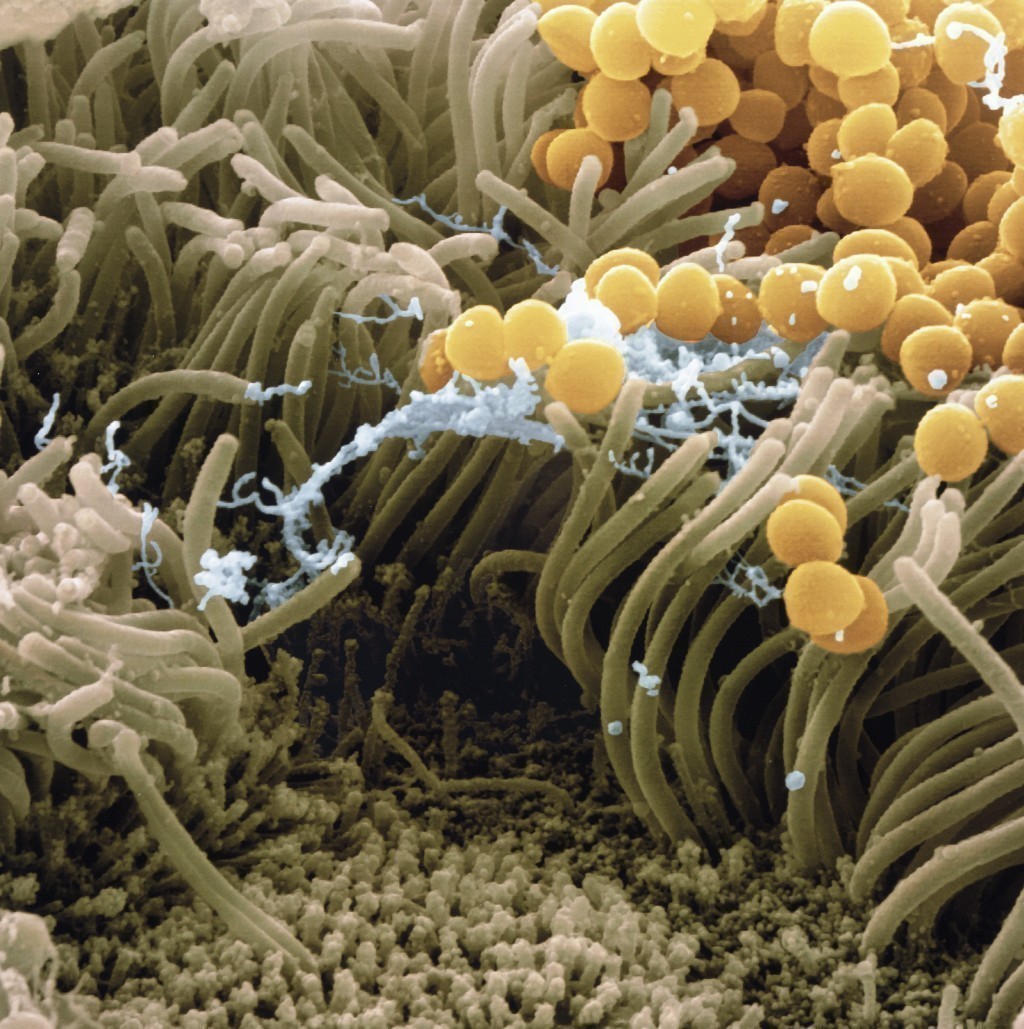 Stafilokok aureus