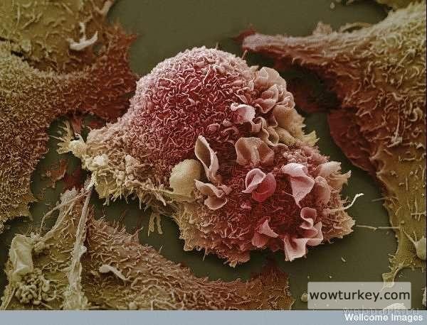 Akciğerdeki Kanser hücresi